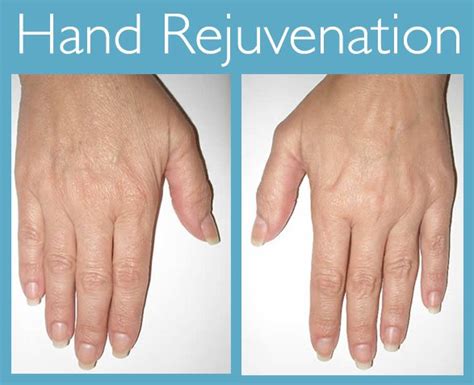 Aging Hands – Dermal Fillers for Hand Rejuvenation Dermatology and Laser Centre