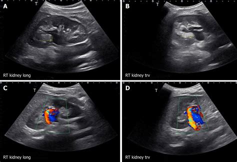 Kidney Ultrasound