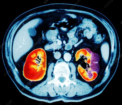 Kidney cancer, abdominal CT scan - Stock Image M134/0458 - Science Photo Library