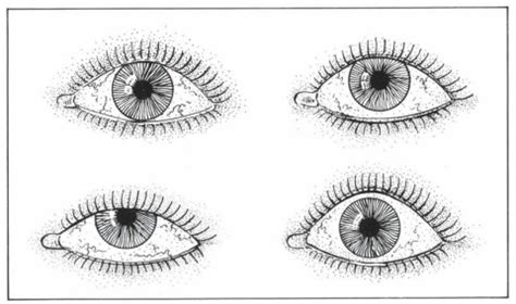 What Is Excessive Scleral Show? | QOVES