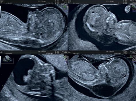 Characteristic fetal profiles with trisomy 21 (upper left), trisomy 18 ...