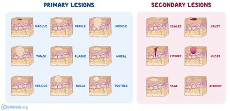 M Word to Describe Skin Lesion Borders