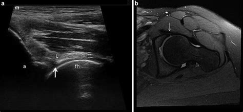 Ultrasound of the Hip | Musculoskeletal Key