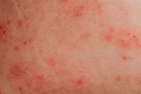 Eczema Triggers: 15 Causes You Might Be Ignoring | The Healthy