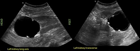 Ultrasound features of Kidney Cysts - Renal Fellow Network