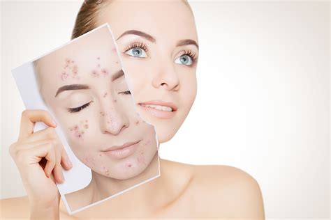 Laser Acne Treatment - Apex Medical Spa