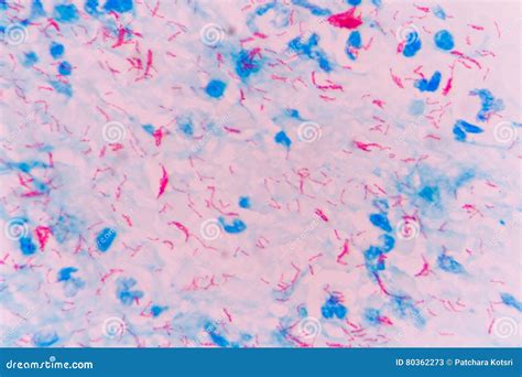 Mycobacterium tuberculosis stock image. Image of infection - 80362273