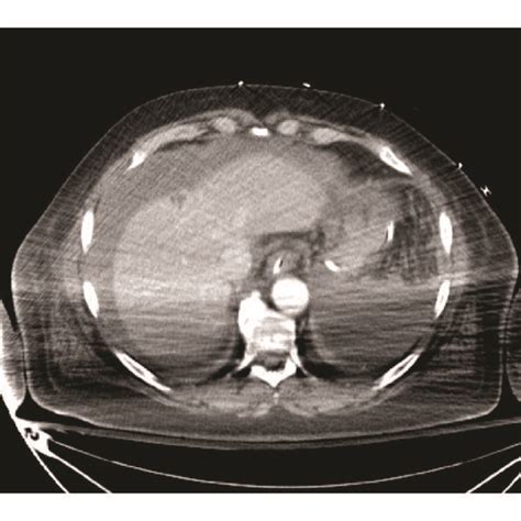 CT scan of abdomen and pelvic showing hemoperitoneum and mass-like... | Download Scientific Diagram