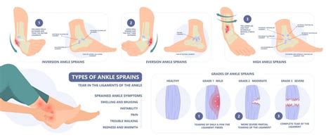 Deltoid Ligament Sprain | How to Treat a Sprain of the Deltoid Ligament