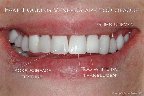 Good Veneers Vs Bad Veneers