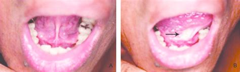 A -Initial clinical appearance; B -Purulent discharge in the right ...