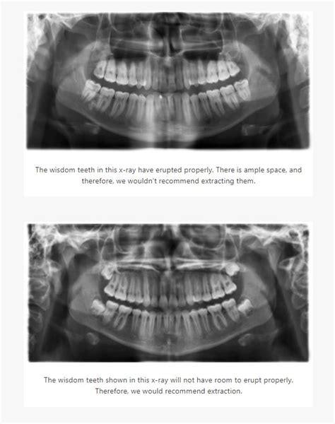 Wisdom Teeth Removal | Sorrento Dental Care