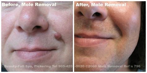 Mole Removal Before & After | Beauty-Full Spa