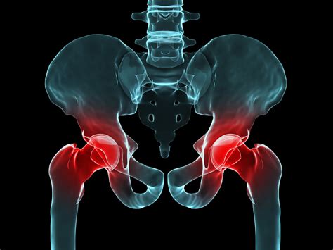 Hip Bursitis Can Cause Pain and Impede Mobility - University Health News