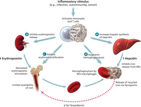 Anemia of chronic disease. Causes, symptoms, treatment Anemia of chronic disease