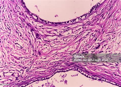 Histology Peritoneal Inclusion Cyst Paraovarian Cysts Hydrosalpinx And Lowgrade Cystic ...