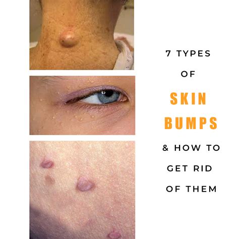 7 Types of Common Skin Bumps (Causes & Treatments)