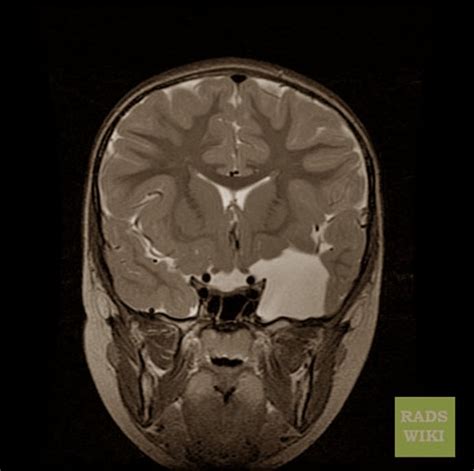 Arachnoid Cyst - Pictures, Symptoms, Causes, Treatment - (2018 - Updated)