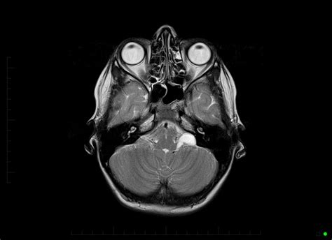 mri-brain-arachnoid-cyst-0001 - MRI at Melbourne Radiology Clinic