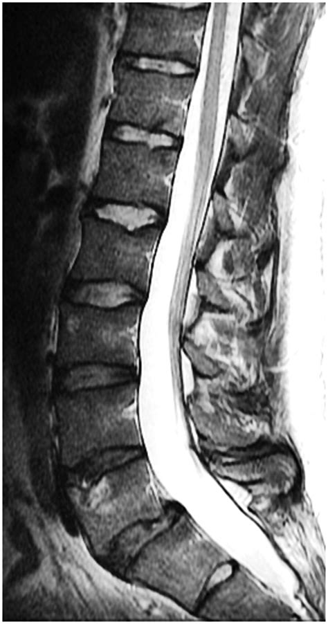 Herniated Lumbar Disc Mri