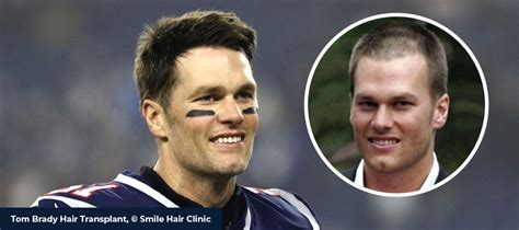 Tom Brady Hair Transplant - Smile Hair Clinic