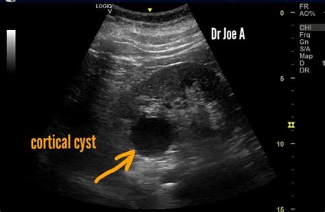 Ultrasound imaging: Simple-renal-cyst