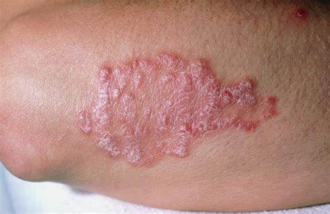 Psoriasis | Causes, Triggers, Diagnosis & Treatment