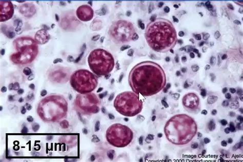 Unit 4-lecture 2 systemic dimorphic fungi Flashcards | Quizlet