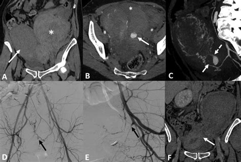 -(A) CT scan without contrast injection in coronal section showing a... | Download Scientific ...