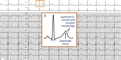 Normal T-waves | Cardiocases