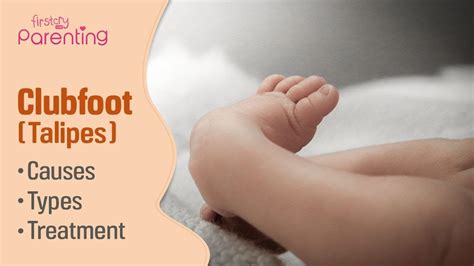 Club Foot (Talipes) in Babies - Causes, Signs & Treatment - YouTube