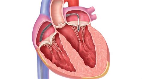 How Long Can You Live With Mitral Valve Regurgitation? - Cluboo