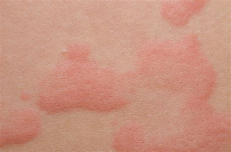 Hives Treatment NYC, Common Causes & Diagnosis - Dr. Michele Green