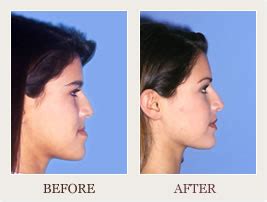 Jaw Surgery Process - Doctor Richard Joseph