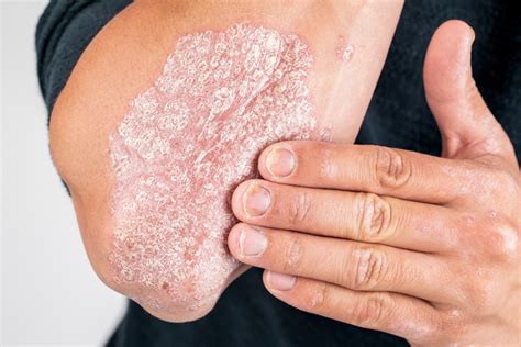 What Is Psoriasis? | Fatty Liver Disease