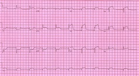 STEMI case examples - wikidoc