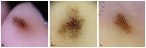 Intradermal Nevus Fibrosis Dermatopathology