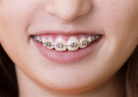 Perfect Braces Colors For Girls Teeth - Beauty and Health Facts