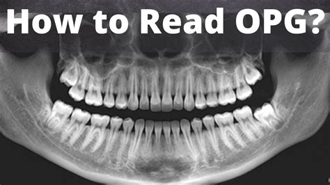 How to read Dental #orthopantomogram (OPG) Anatomical Landmarks ...