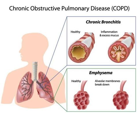 COPD | Asthma Foundation NZ