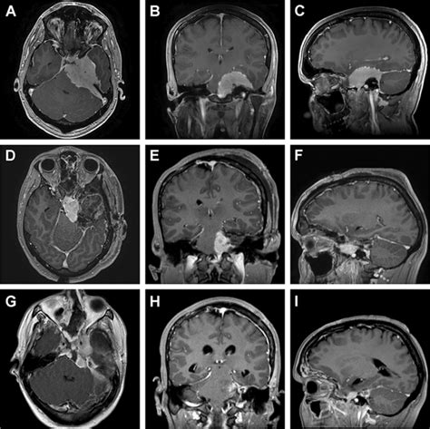 Illustrative case of a 36-year-old man with a petroclival meningioma... | Download Scientific ...