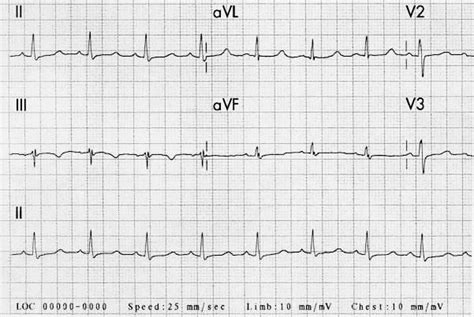 Hypocalcemia Ecg Changes