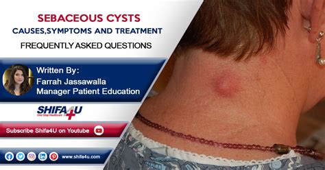 Sebaceous Cysts Causes, Symptoms & Treatment