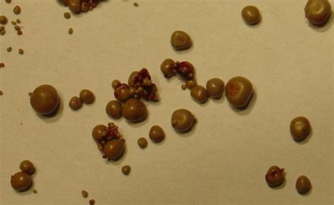 uric acid kidney stones | SeeReadShare