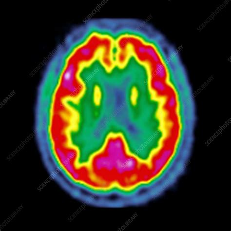 Normal brain activity, PET scan - Stock Image - C026/7612 - Science Photo Library