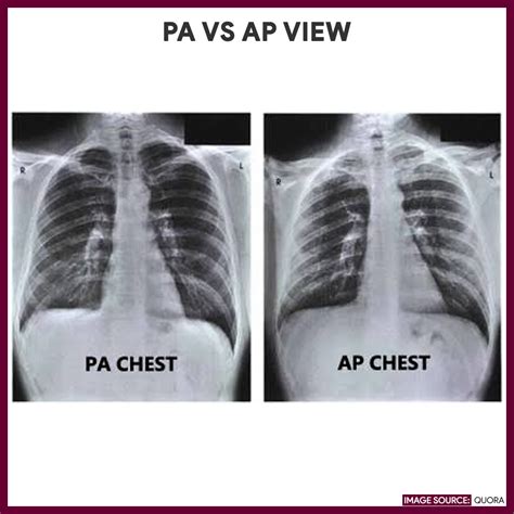 Chest X-ray (Chest Radiography) - Nursing Responsibilities - Nurseslabs