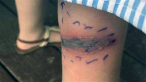 This Girl's 'Bruise' Was Actually Venom From a Black Widow Spider Bite | SELF