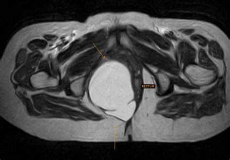 Perirectal Cyst-Differentials - Sumer's Radiology Blog