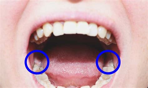 Impacted Wisdom Teeth—Their Causes, Symptoms, and Treatment