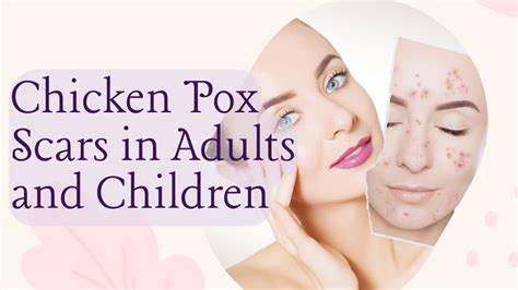 How to Remove Chicken Pox Scars in Adults Or Children